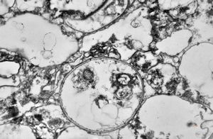 M,50y. | Pneumocystis carinii